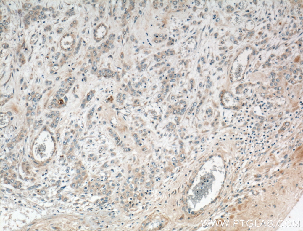 IHC staining of human colon cancer using 15402-1-AP