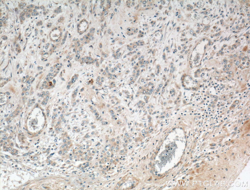 Immunohistochemistry (IHC) staining of human colon cancer tissue using USP30 Polyclonal antibody (15402-1-AP)