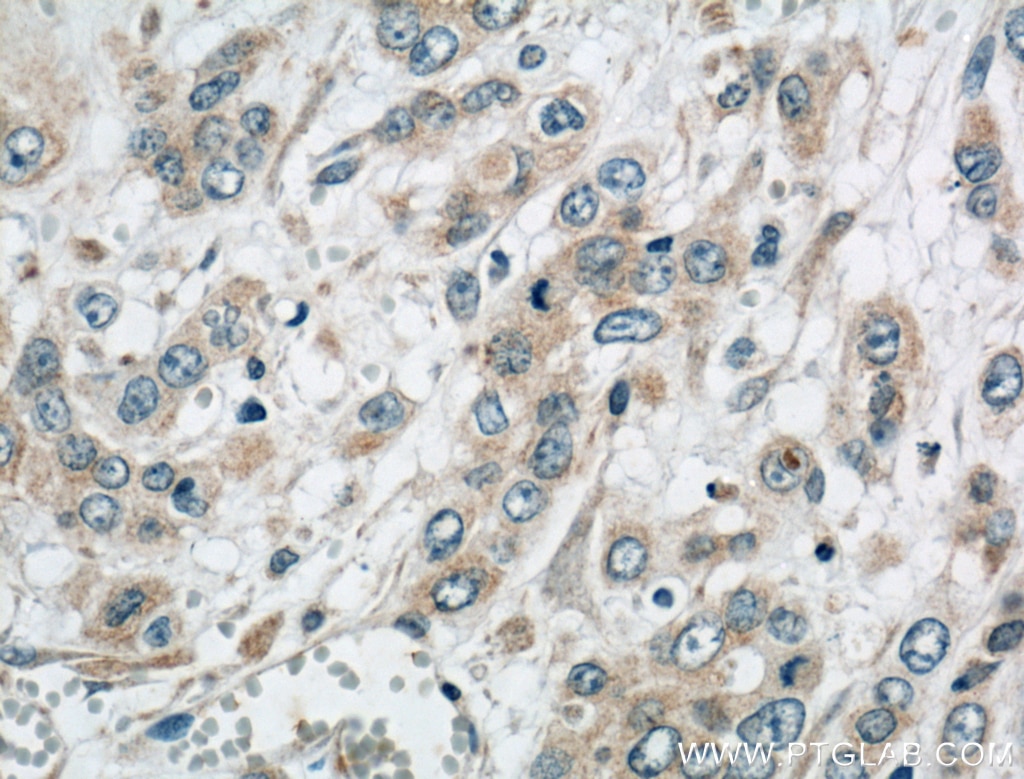 Immunohistochemistry (IHC) staining of human colon cancer tissue using USP30 Polyclonal antibody (15402-1-AP)