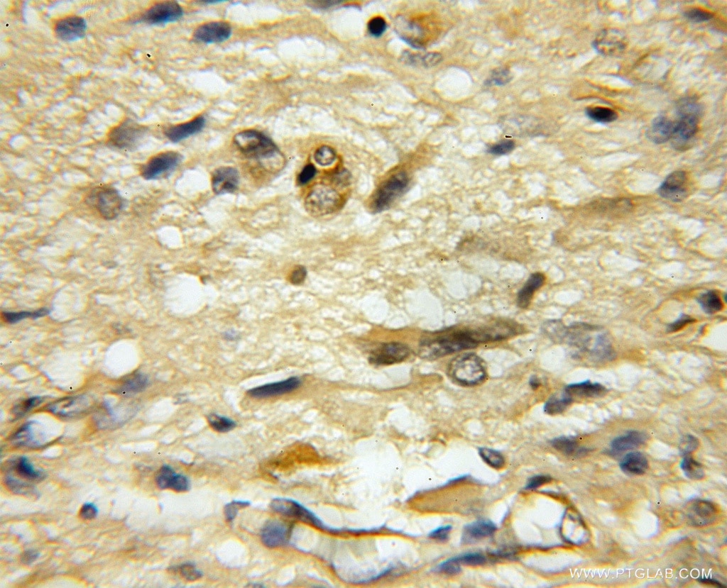 Immunohistochemistry (IHC) staining of human medulloblastoma tissue using USP33 Polyclonal antibody (12060-2-AP)