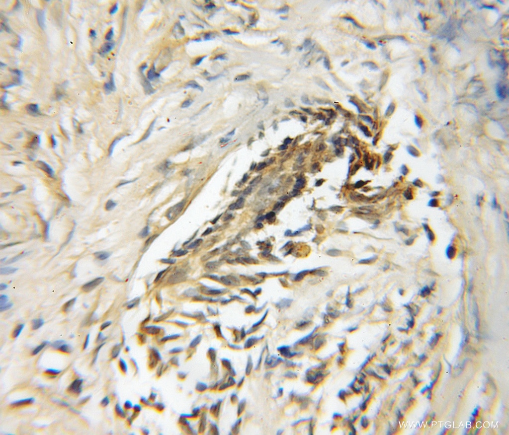 Immunohistochemistry (IHC) staining of human prostate cancer tissue using USP33 Polyclonal antibody (12060-2-AP)