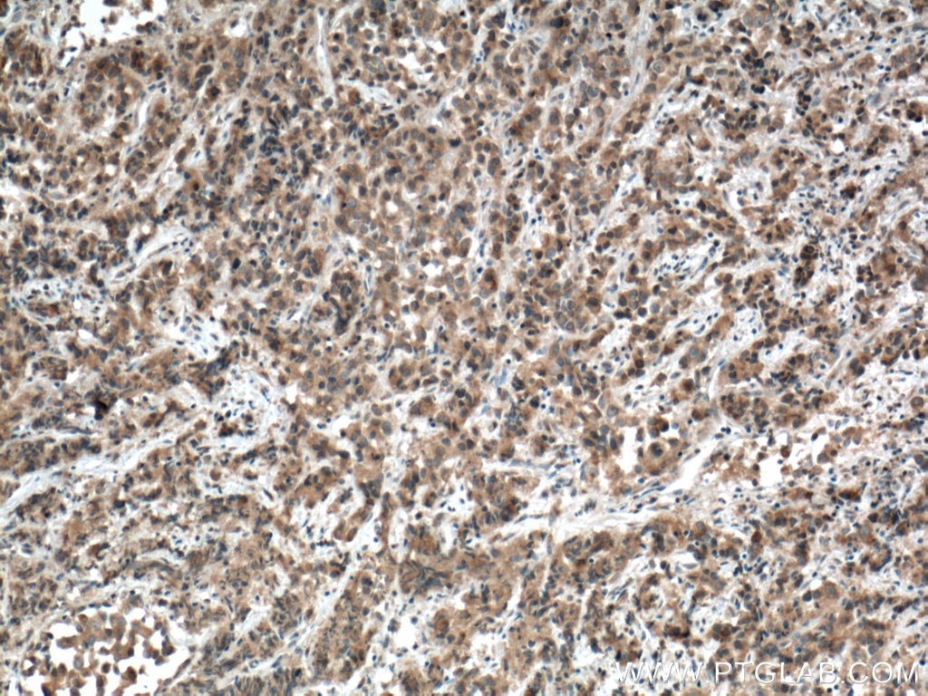 Immunohistochemistry (IHC) staining of human prostate cancer tissue using USP33 Polyclonal antibody (20445-1-AP)