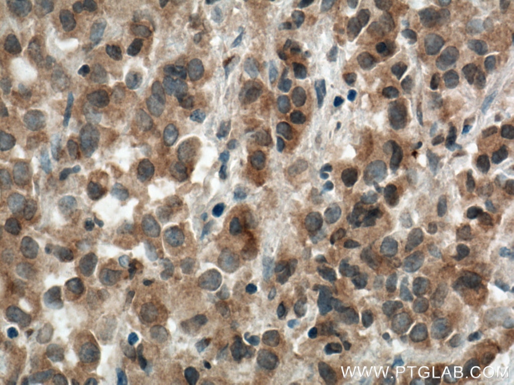Immunohistochemistry (IHC) staining of human prostate cancer tissue using USP33 Polyclonal antibody (20445-1-AP)
