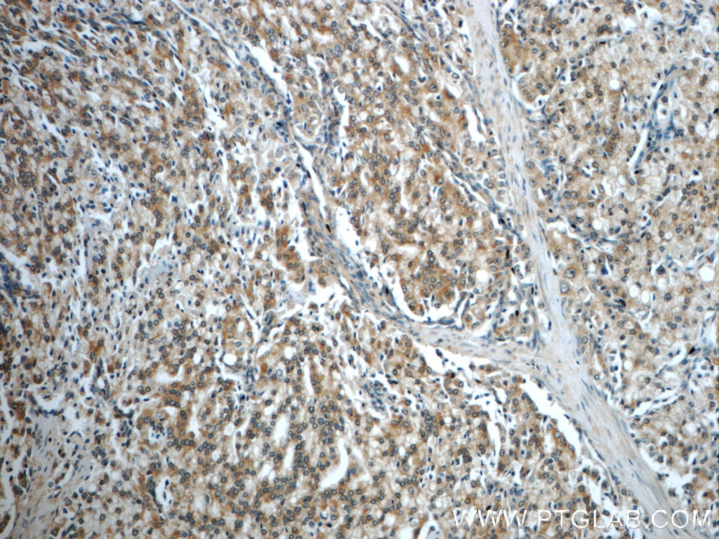 Immunohistochemistry (IHC) staining of human prostate cancer tissue using USP33 Polyclonal antibody (20445-1-AP)