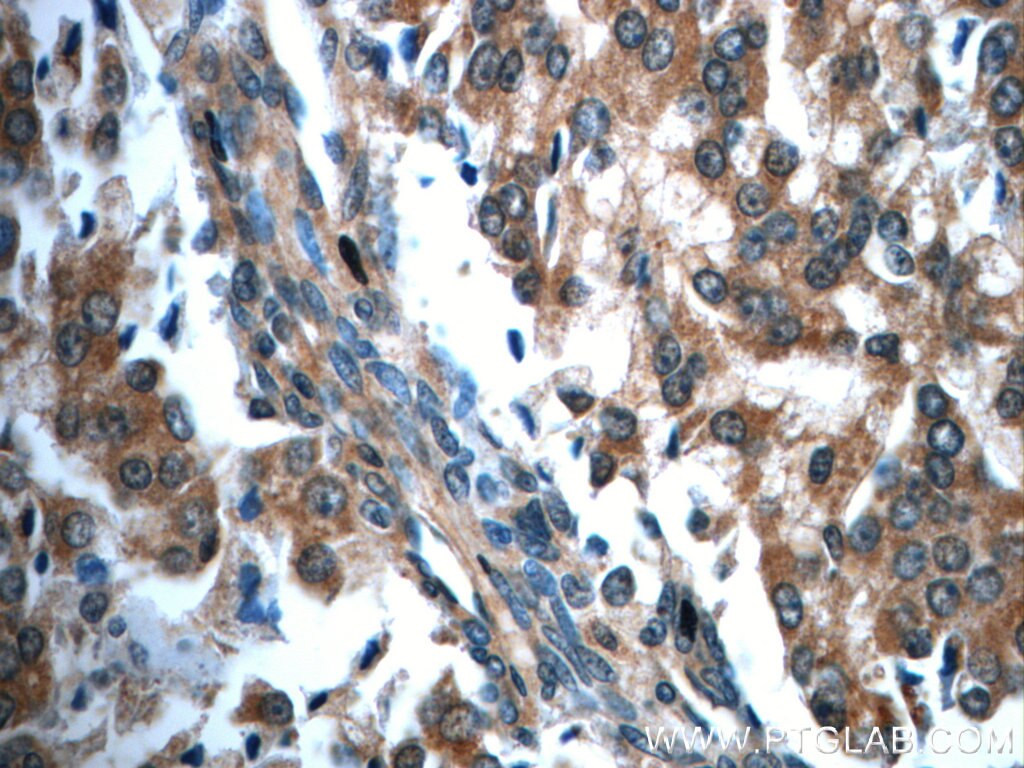 Immunohistochemistry (IHC) staining of human prostate cancer tissue using USP33 Polyclonal antibody (20445-1-AP)