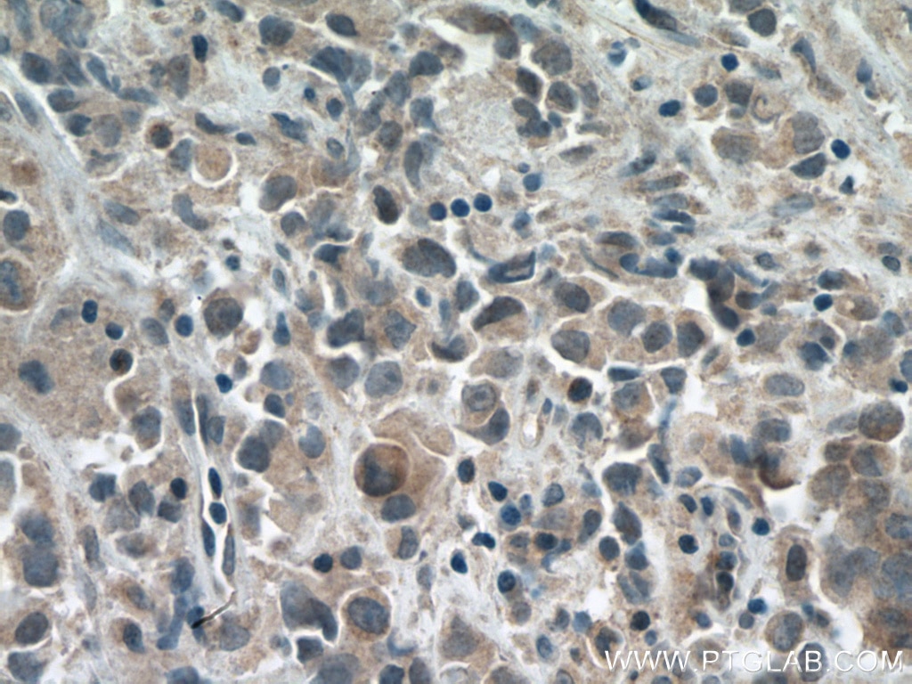 Immunohistochemistry (IHC) staining of human prostate cancer tissue using USP34 Polyclonal antibody (18827-1-AP)