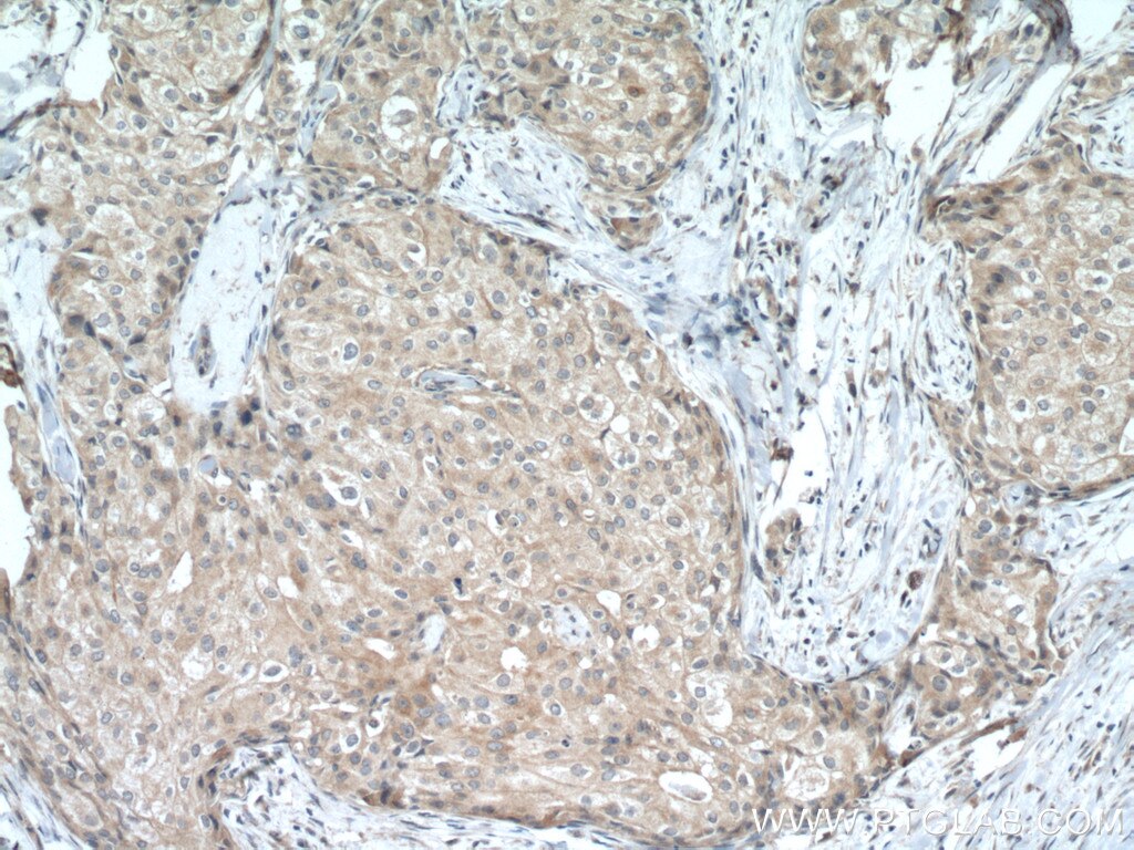 Immunohistochemistry (IHC) staining of human breast cancer tissue using USP34 Polyclonal antibody (18827-1-AP)