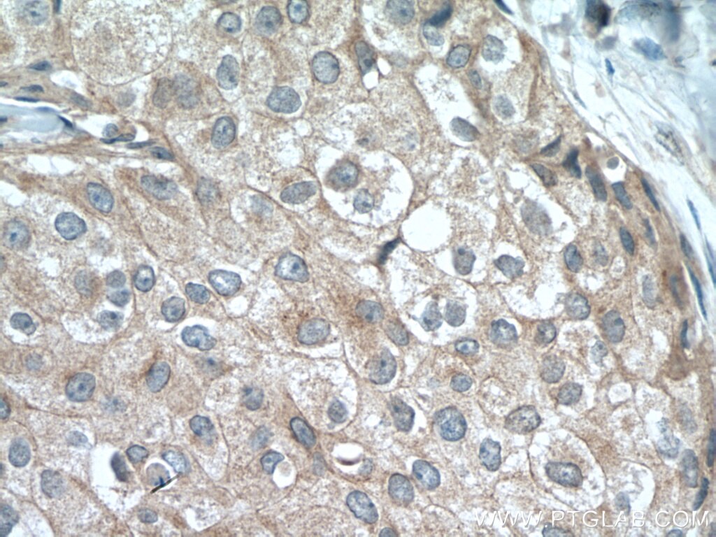 Immunohistochemistry (IHC) staining of human breast cancer tissue using USP34 Polyclonal antibody (18827-1-AP)