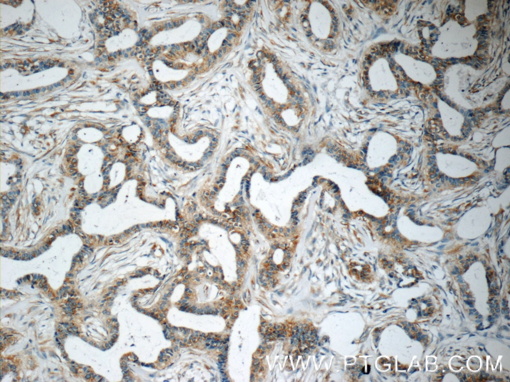 Immunohistochemistry (IHC) staining of human breast cancer tissue using USP34 Polyclonal antibody (18827-1-AP)