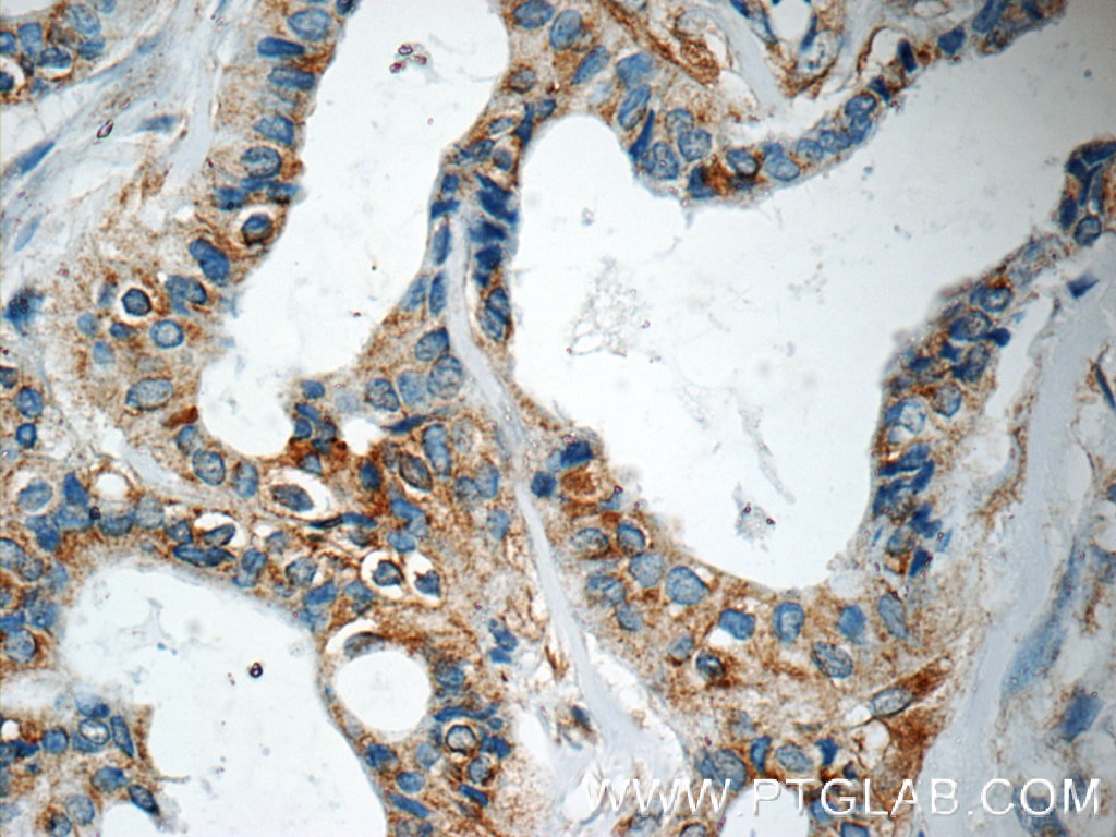 Immunohistochemistry (IHC) staining of human breast cancer tissue using USP34 Polyclonal antibody (18827-1-AP)