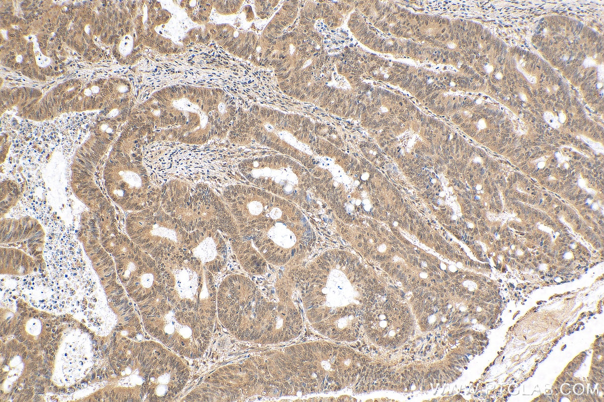 Immunohistochemistry (IHC) staining of human colon cancer tissue using USP35 Polyclonal antibody (24559-1-AP)