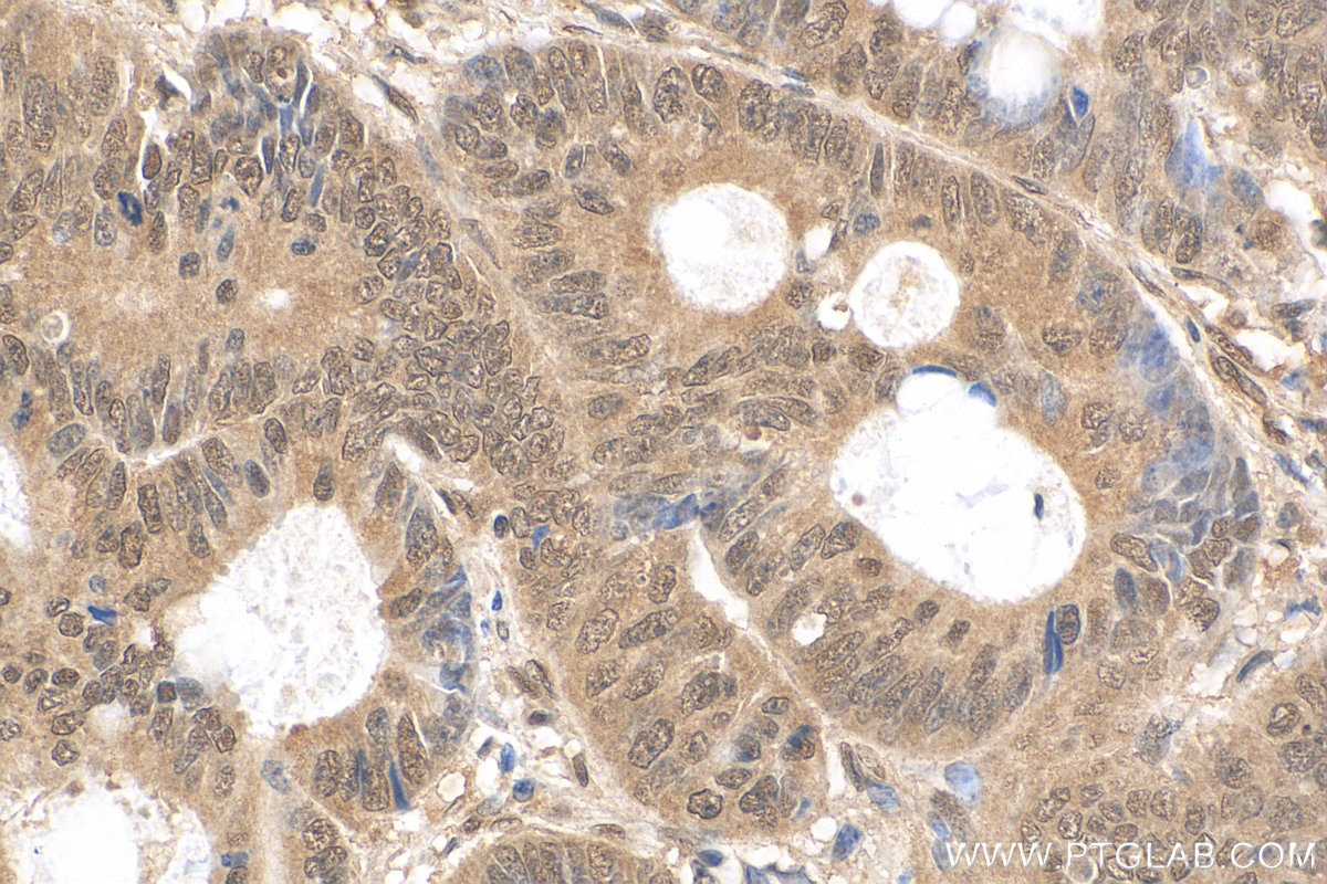 Immunohistochemistry (IHC) staining of human colon cancer tissue using USP35 Polyclonal antibody (24559-1-AP)