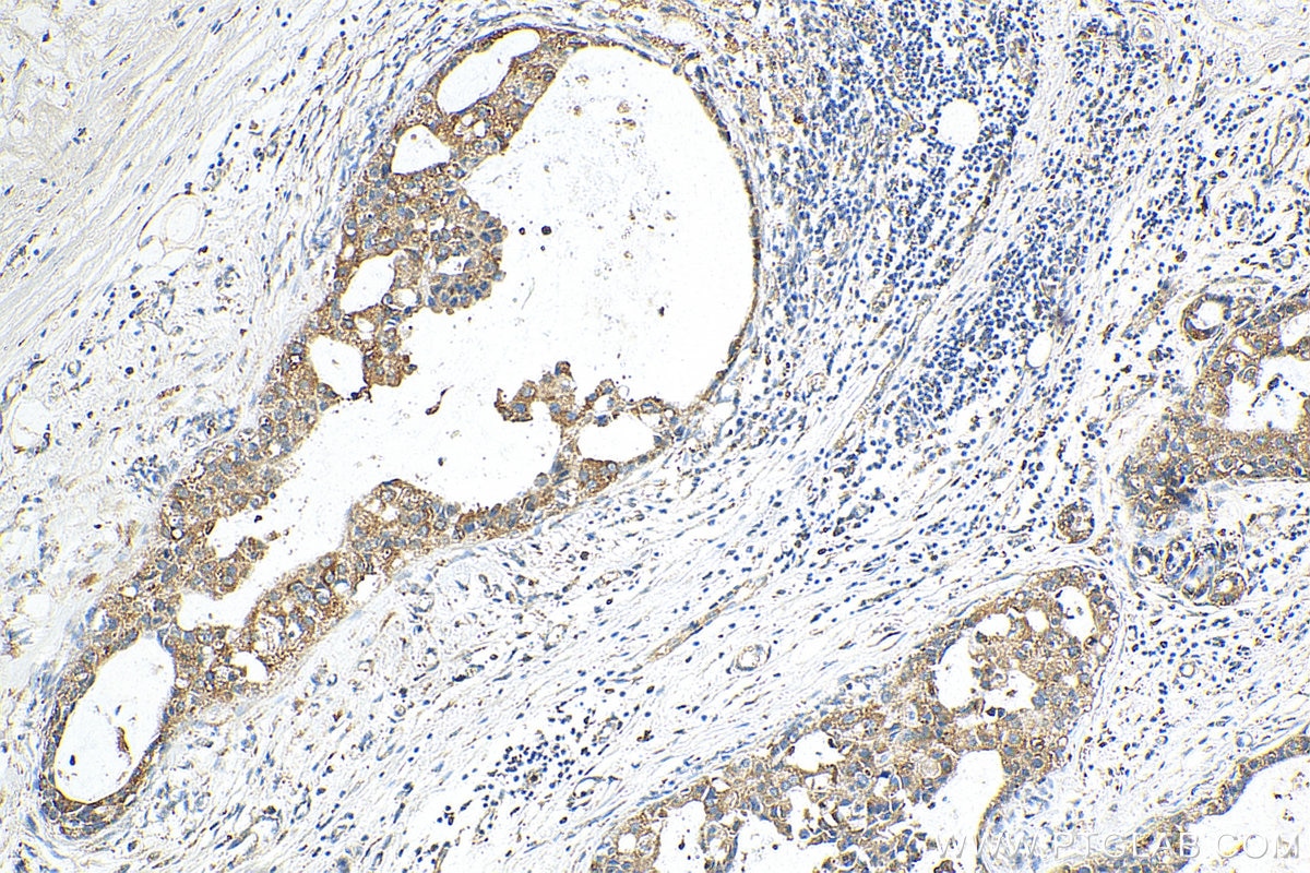 Immunohistochemistry (IHC) staining of human breast cancer tissue using USP37 Polyclonal antibody (18465-1-AP)