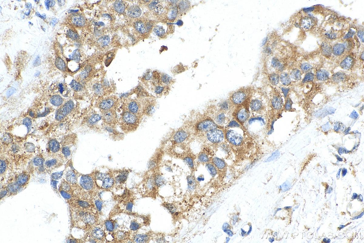 Immunohistochemistry (IHC) staining of human breast cancer tissue using USP37 Polyclonal antibody (18465-1-AP)