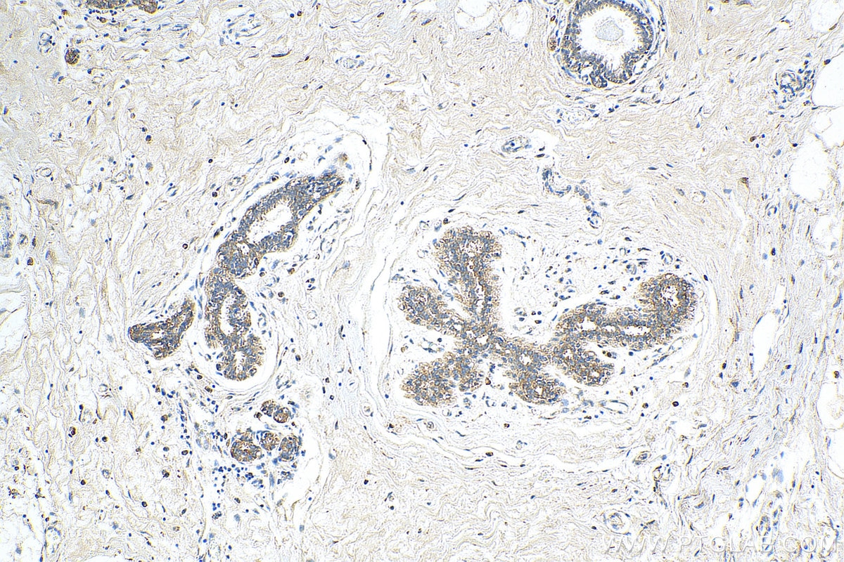 Immunohistochemistry (IHC) staining of human breast cancer tissue using USP37 Polyclonal antibody (18465-1-AP)