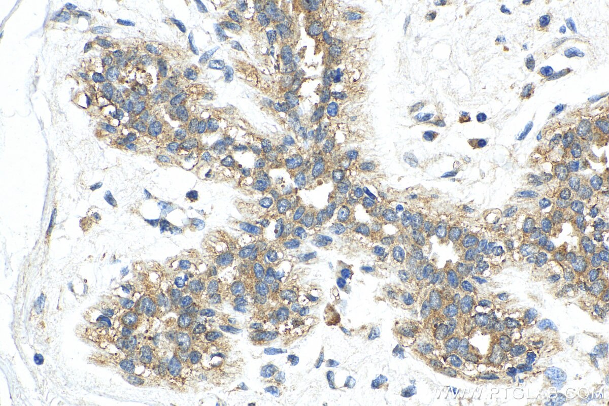 Immunohistochemistry (IHC) staining of human breast cancer tissue using USP37 Polyclonal antibody (18465-1-AP)