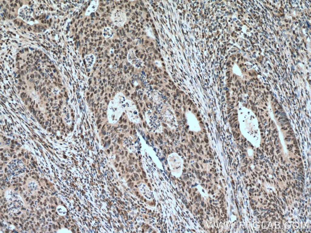 IHC staining of human colon cancer using 23865-1-AP