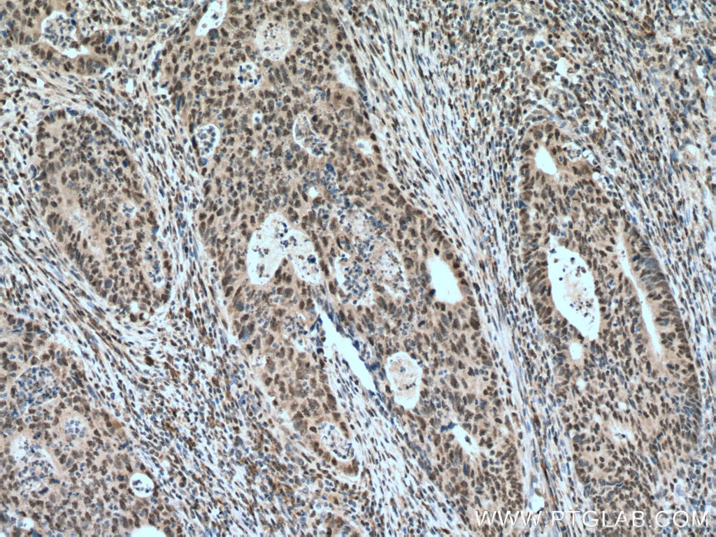 Immunohistochemistry (IHC) staining of human colon cancer tissue using USP39 Polyclonal antibody (23865-1-AP)