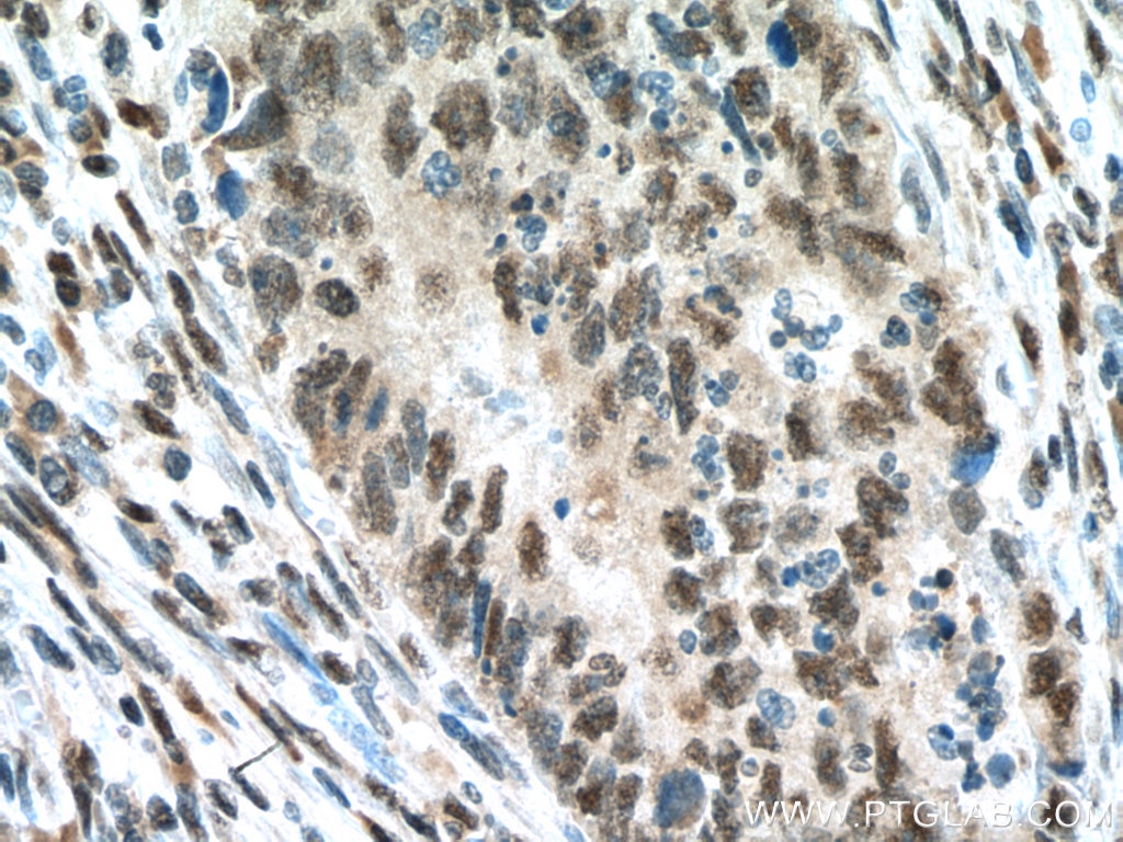 Immunohistochemistry (IHC) staining of human colon cancer tissue using USP39 Polyclonal antibody (23865-1-AP)