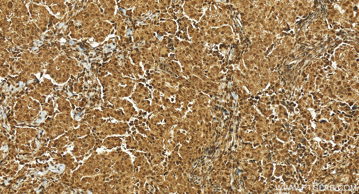 Immunohistochemistry (IHC) staining of human ovary cancer tissue using USP4 Polyclonal antibody (24976-1-AP)
