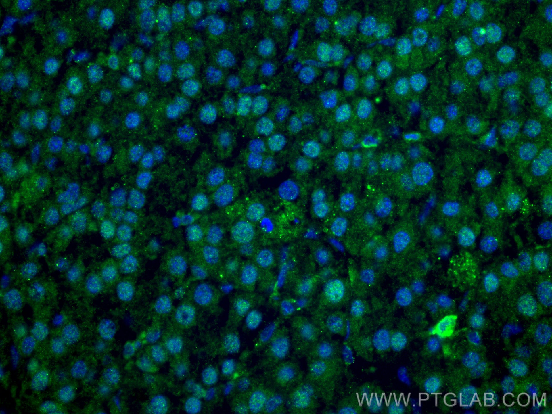 Immunofluorescence (IF) / fluorescent staining of human liver cancer tissue using USP4 Monoclonal antibody (66822-1-Ig)