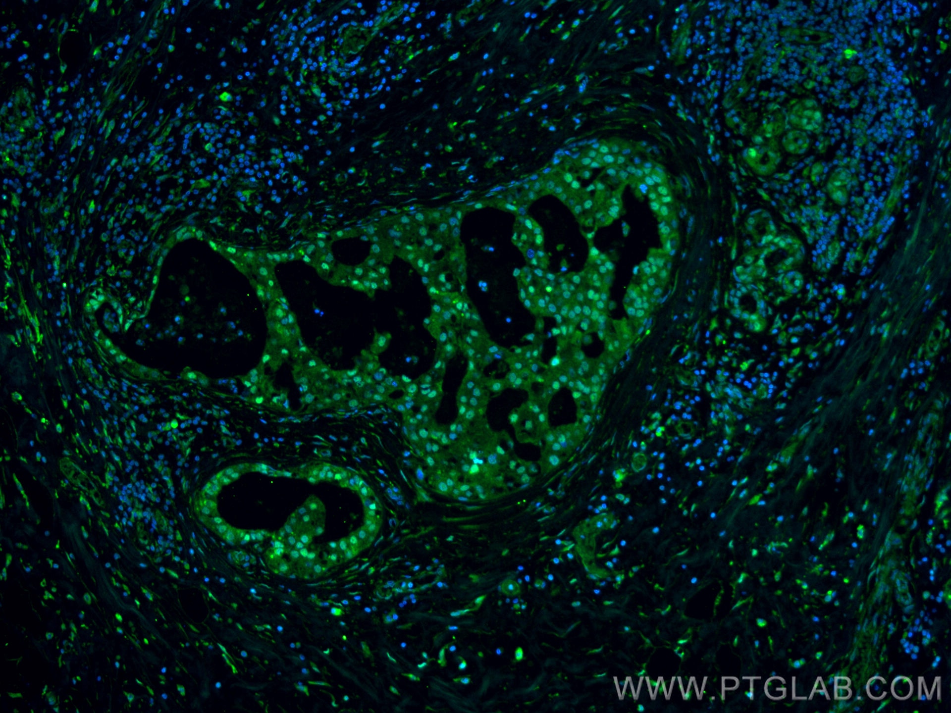 Immunofluorescence (IF) / fluorescent staining of human breast cancer tissue using USP4 Monoclonal antibody (66822-1-Ig)
