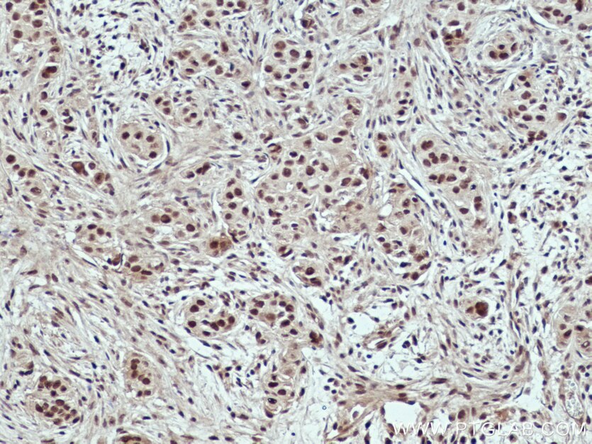Immunohistochemistry (IHC) staining of human breast cancer tissue using USP4 Monoclonal antibody (66822-1-Ig)