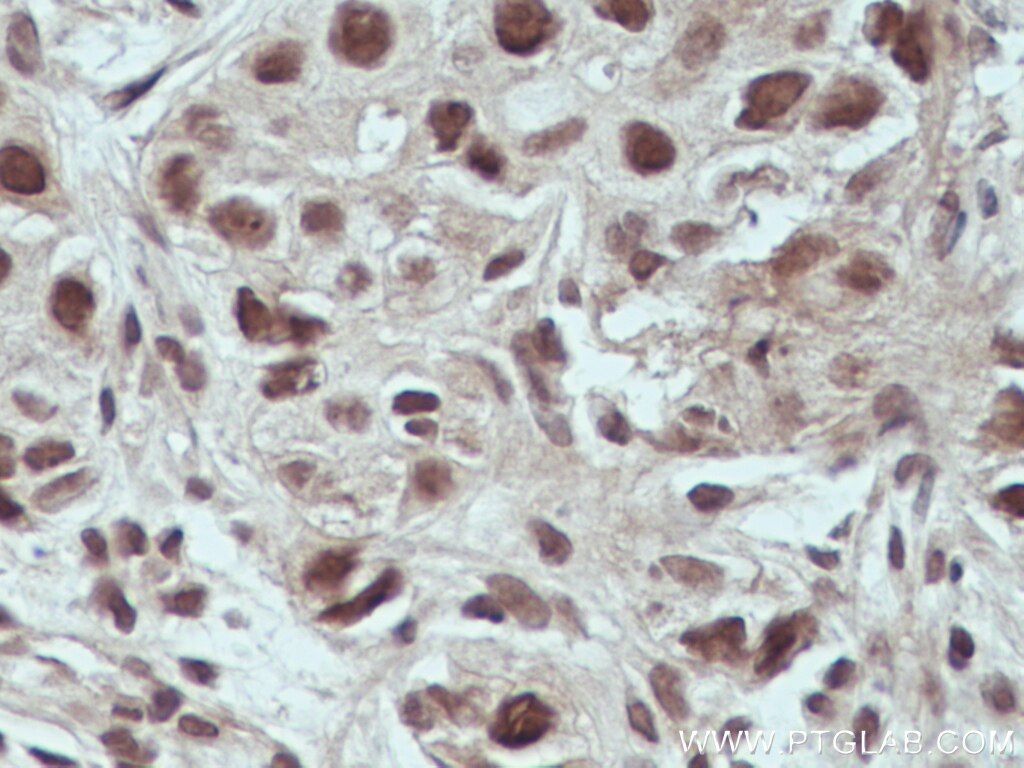 Immunohistochemistry (IHC) staining of human breast cancer tissue using USP4 Monoclonal antibody (66822-1-Ig)