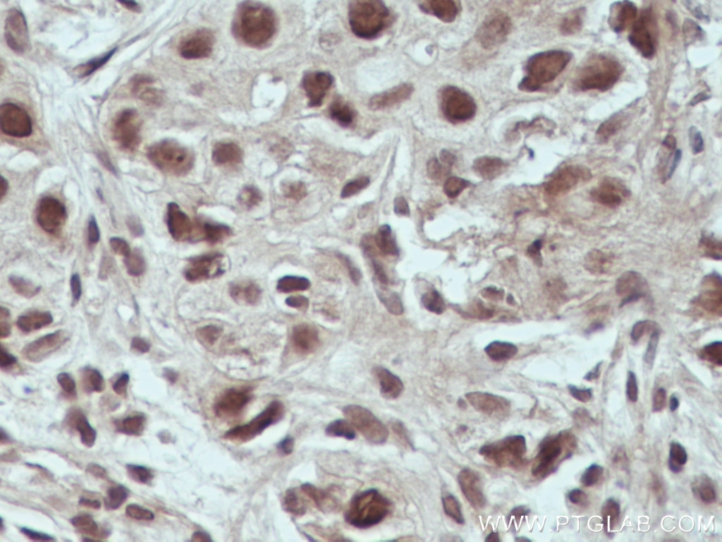 Immunohistochemistry (IHC) staining of human breast cancer tissue using USP4 Monoclonal antibody (66822-1-Ig)