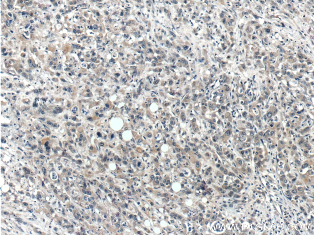 Immunohistochemistry (IHC) staining of human stomach cancer tissue using USP45 Polyclonal antibody (15866-1-AP)