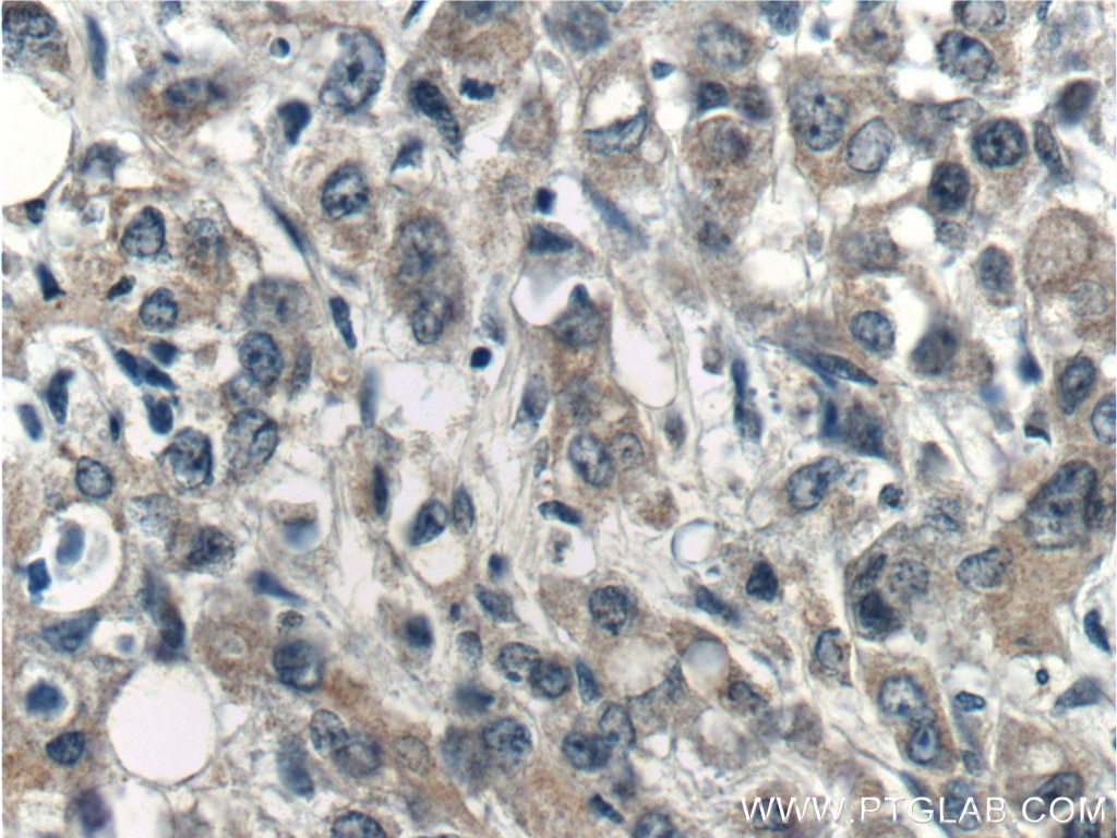 Immunohistochemistry (IHC) staining of human stomach cancer tissue using USP45 Polyclonal antibody (15866-1-AP)