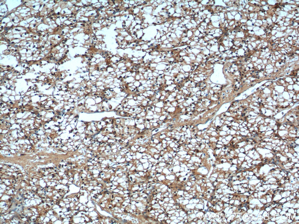 Immunohistochemistry (IHC) staining of human renal cell carcinoma tissue using USP46 Polyclonal antibody (13502-1-AP)
