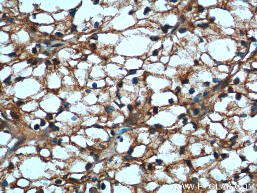 Immunohistochemistry (IHC) staining of human renal cell carcinoma tissue using USP46 Polyclonal antibody (13502-1-AP)