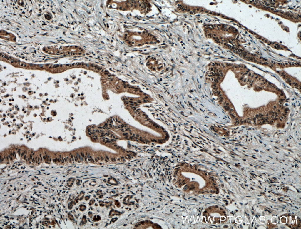 Immunohistochemistry (IHC) staining of human pancreas cancer tissue using USP48 Polyclonal antibody (12076-1-AP)