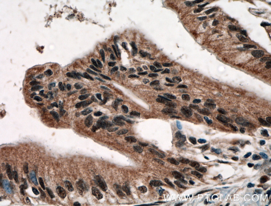 Immunohistochemistry (IHC) staining of human pancreas cancer tissue using USP48 Polyclonal antibody (12076-1-AP)