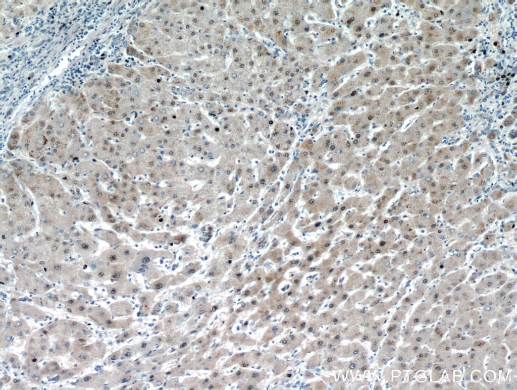 Immunohistochemistry (IHC) staining of human hepatocirrhosis tissue using USP50 Polyclonal antibody (20374-1-AP)