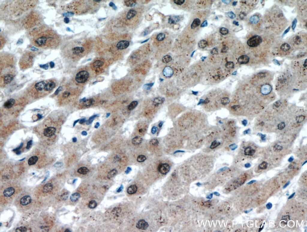 Immunohistochemistry (IHC) staining of human hepatocirrhosis tissue using USP50 Polyclonal antibody (20374-1-AP)