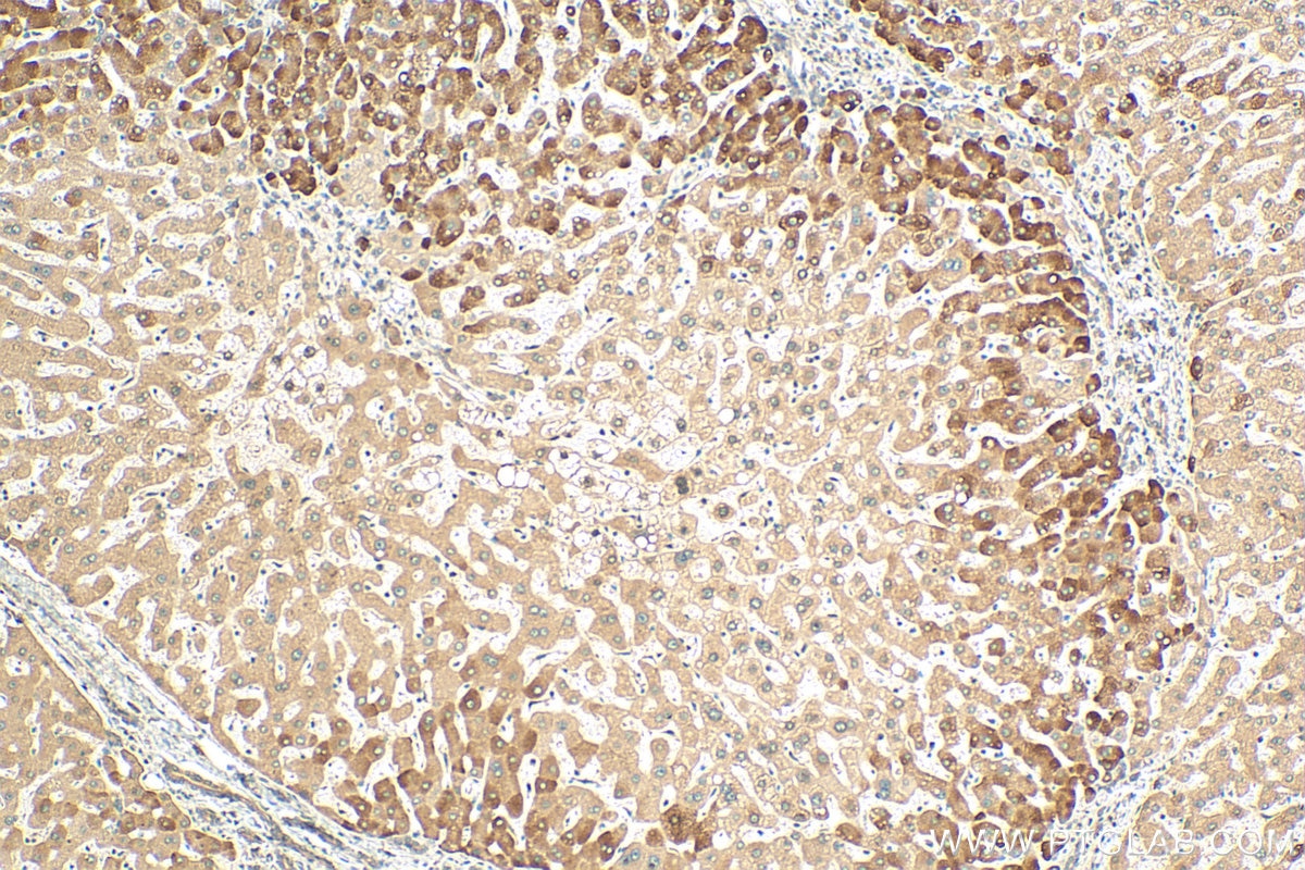 IHC staining of human hepatocirrhosis using 24817-1-AP