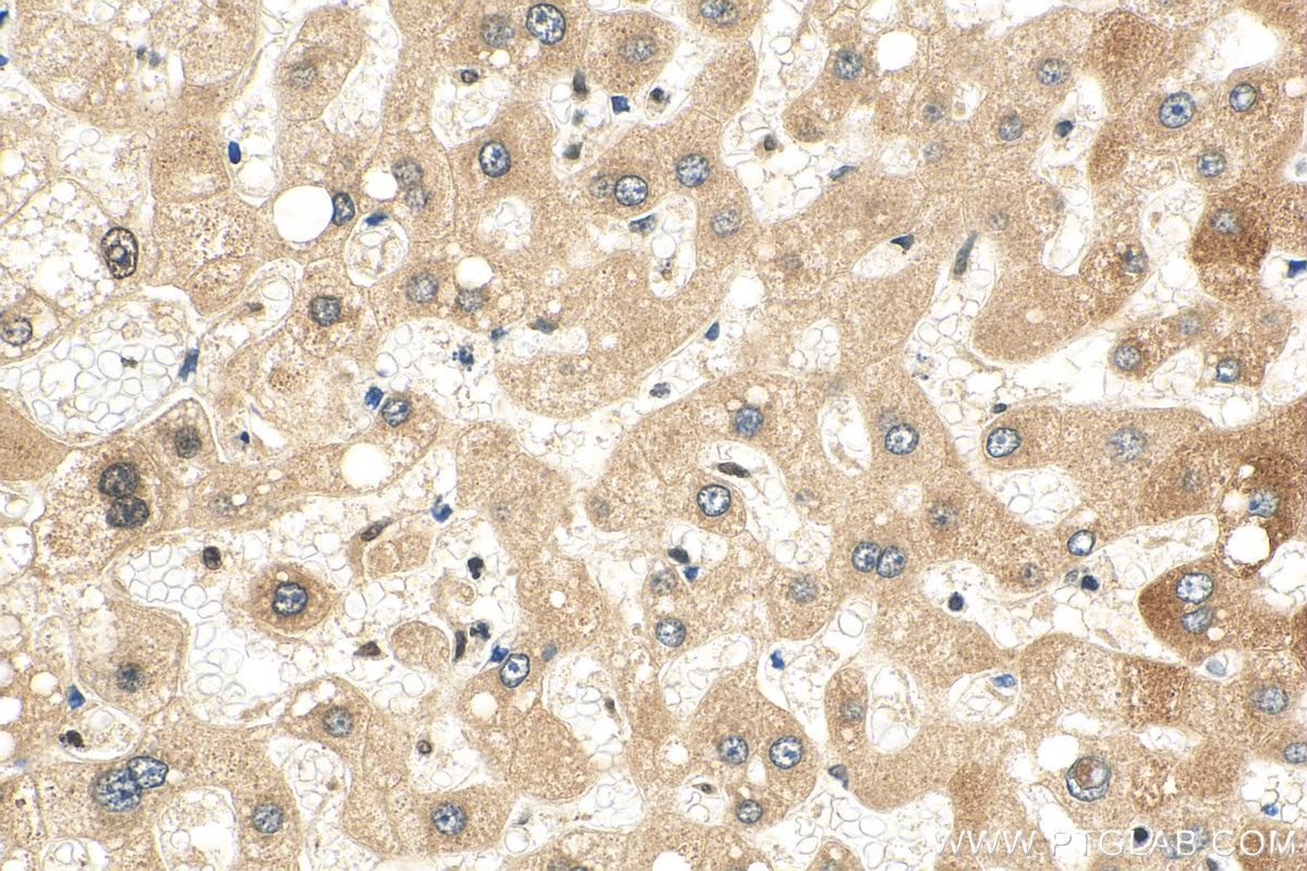 Immunohistochemistry (IHC) staining of human hepatocirrhosis tissue using USP50 Polyclonal antibody (24817-1-AP)