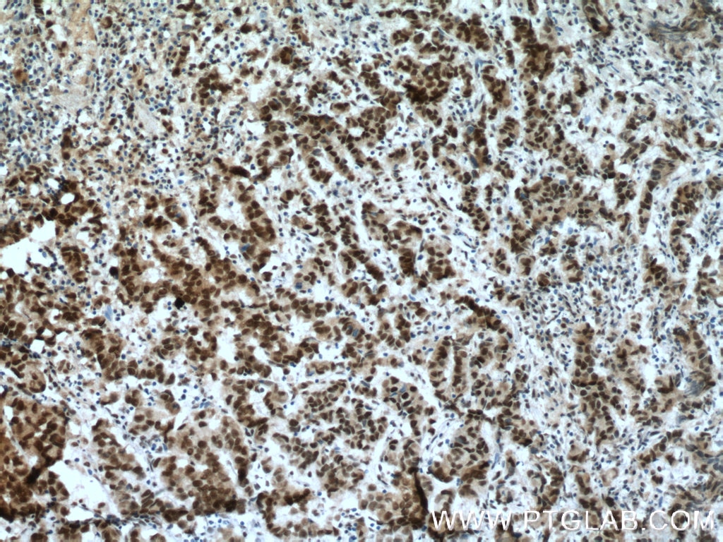 Immunohistochemistry (IHC) staining of human prostate cancer tissue using USP7 Polyclonal antibody (26948-1-AP)