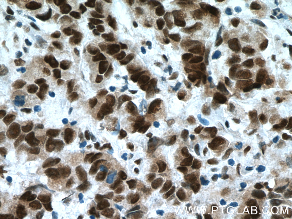 Immunohistochemistry (IHC) staining of human prostate cancer tissue using USP7 Polyclonal antibody (26948-1-AP)