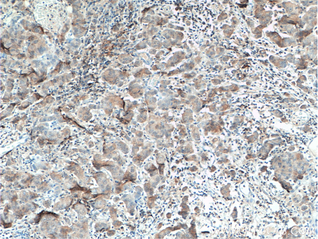 Immunohistochemistry (IHC) staining of human prostate cancer tissue using USP7 Monoclonal antibody (66514-1-Ig)