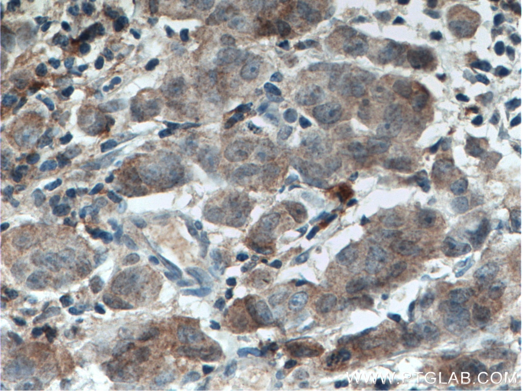 Immunohistochemistry (IHC) staining of human prostate cancer tissue using USP7 Monoclonal antibody (66514-1-Ig)