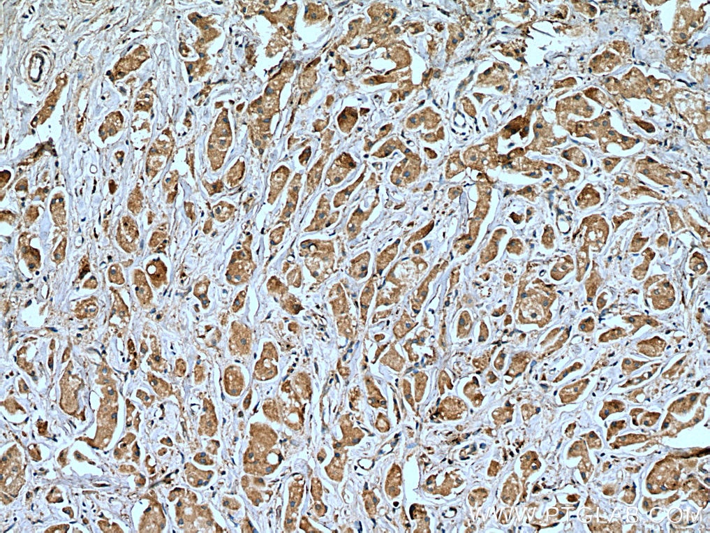 Immunohistochemistry (IHC) staining of human breast cancer tissue using USP8 Monoclonal antibody (67321-1-Ig)