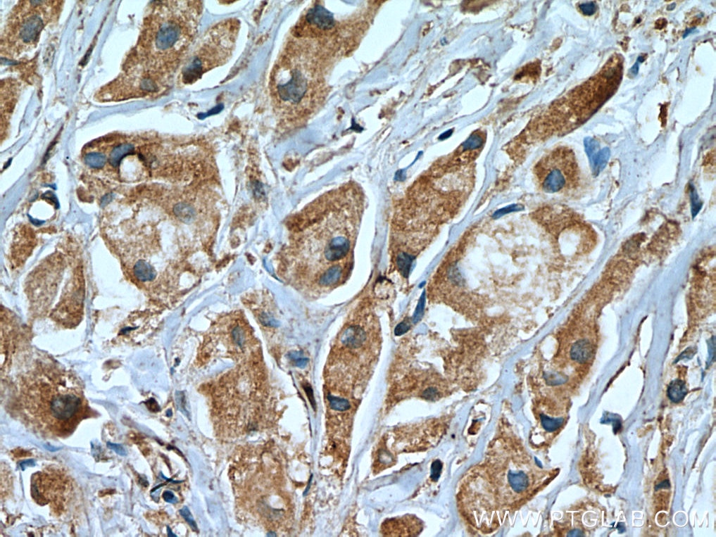 Immunohistochemistry (IHC) staining of human breast cancer tissue using USP8 Monoclonal antibody (67321-1-Ig)