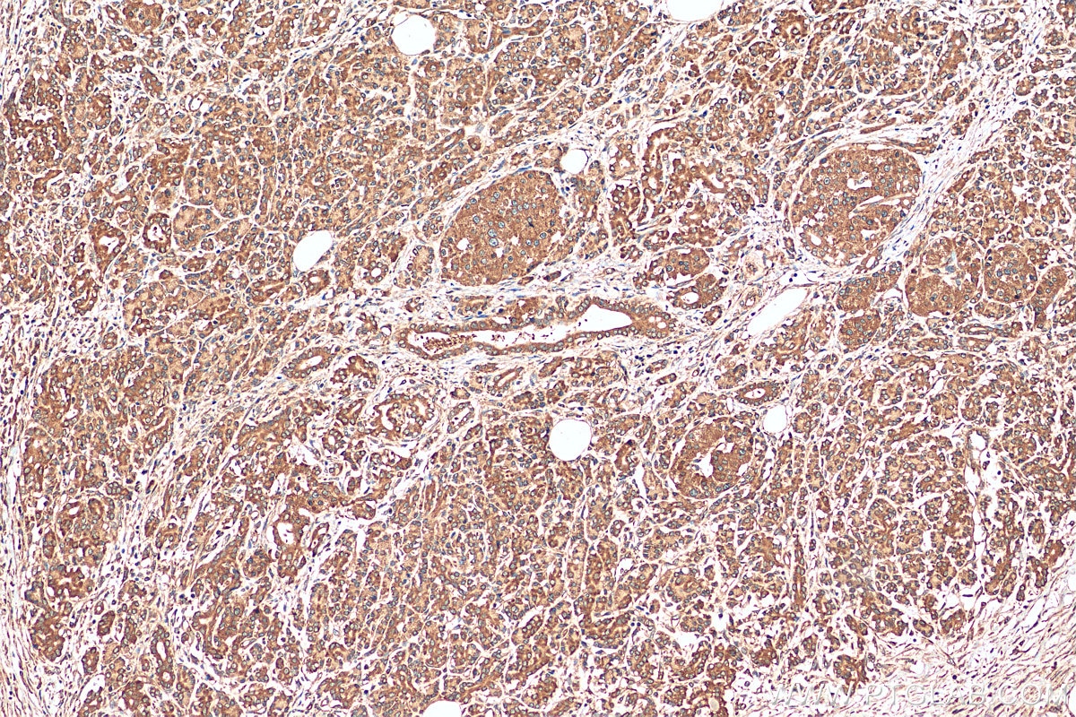 IHC staining of human pancreas cancer using 55054-1-AP
