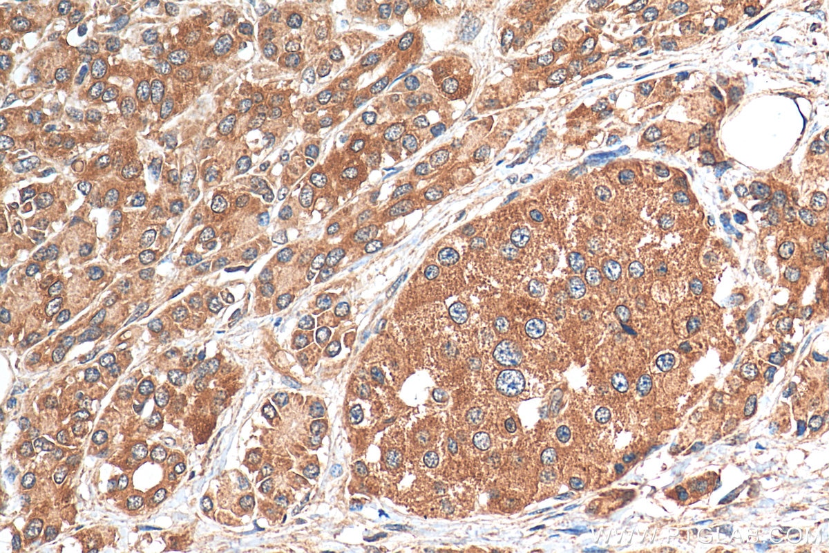 IHC staining of human pancreas cancer using 55054-1-AP