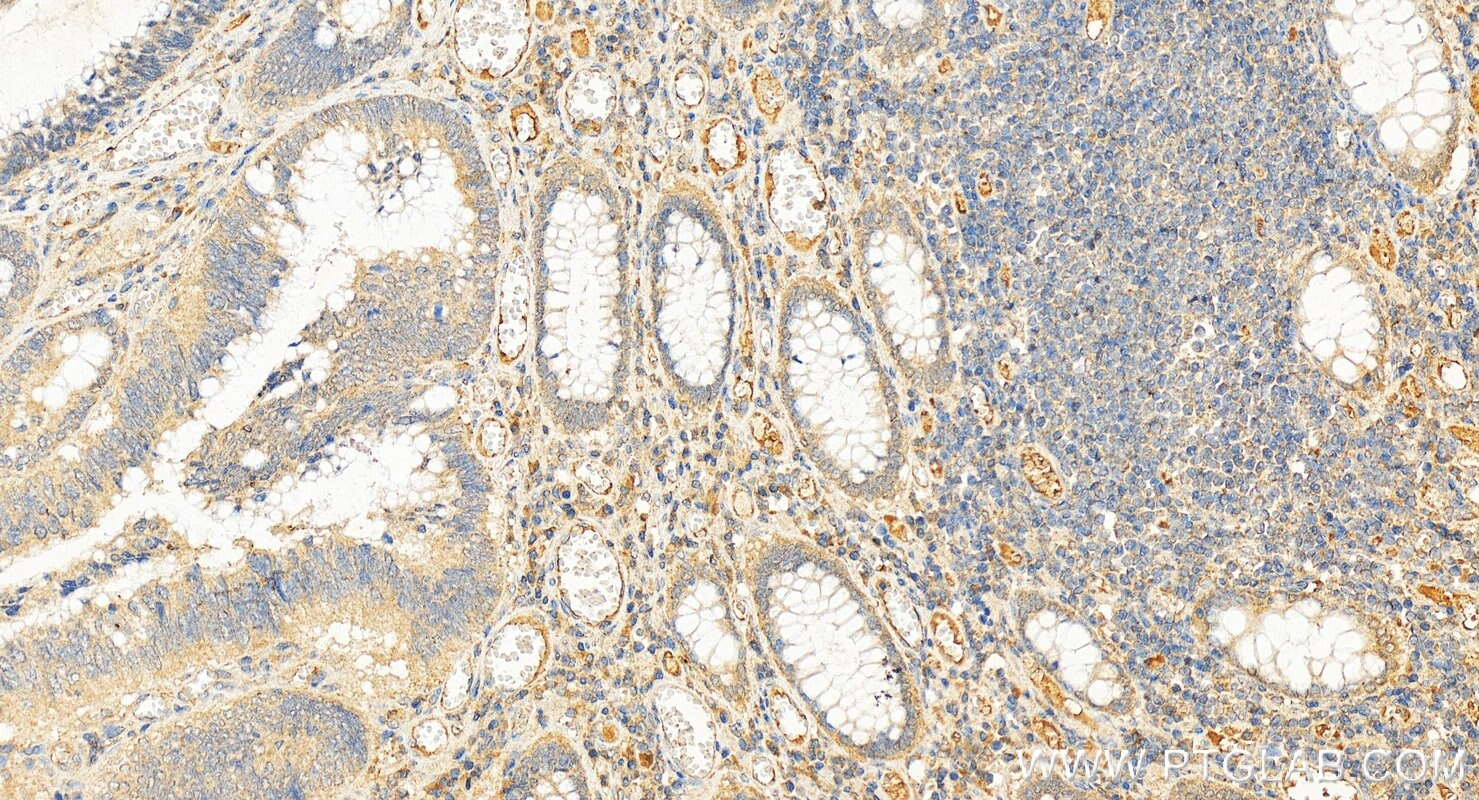 Immunohistochemistry (IHC) staining of human colon cancer tissue using UST Polyclonal antibody (27578-1-AP)