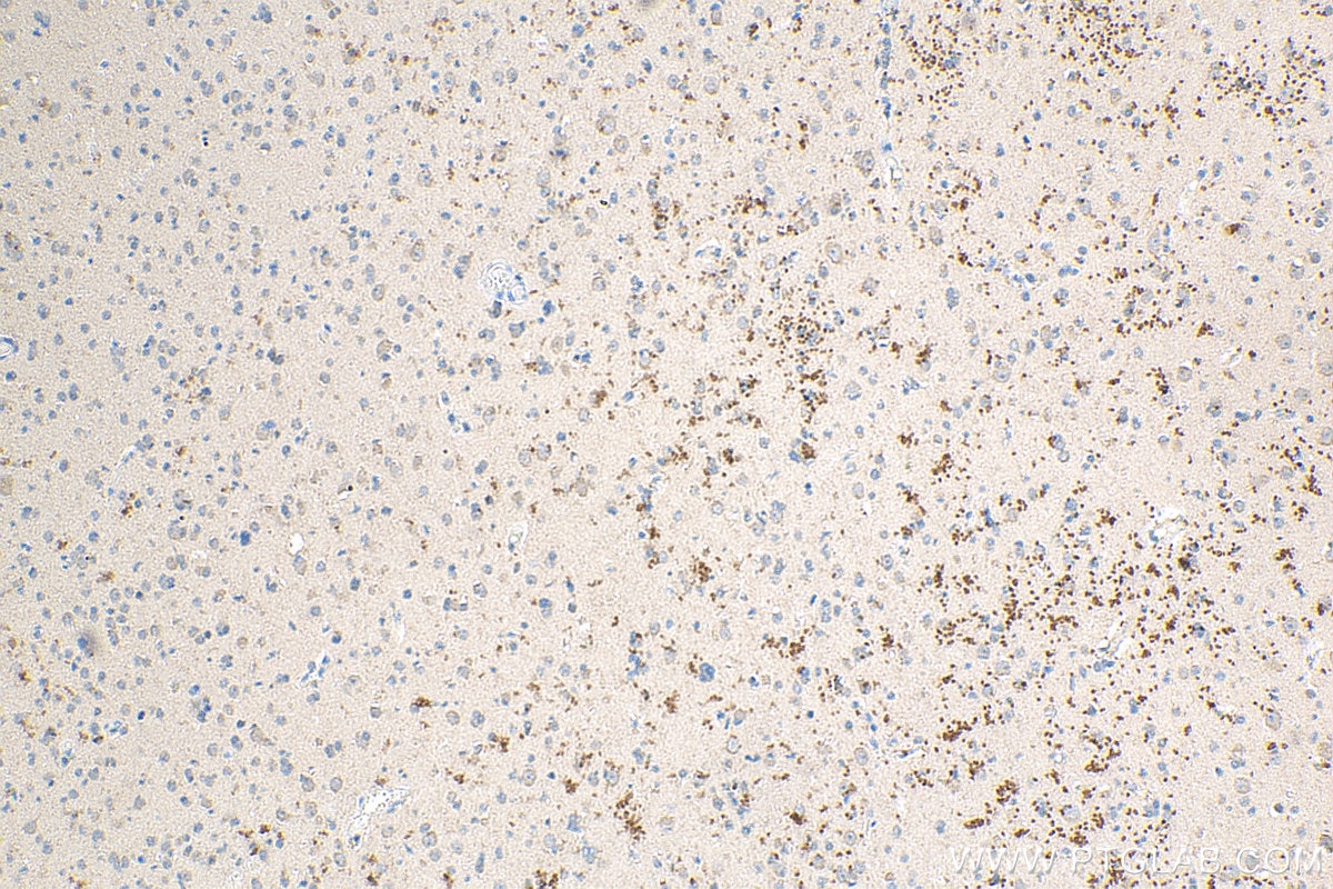IHC staining of human gliomas using 23516-1-AP