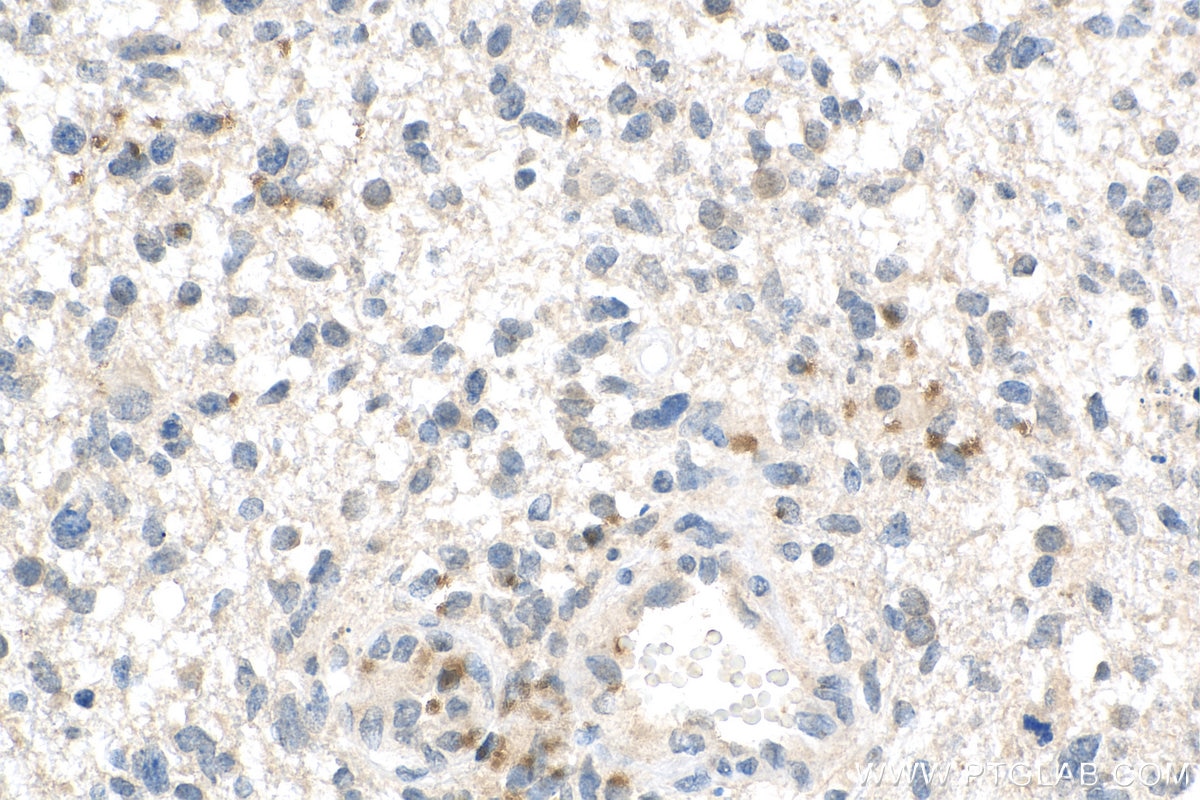 IHC staining of human gliomas using 23516-1-AP